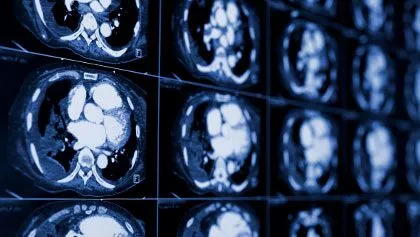image of brain scan