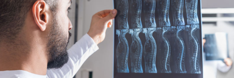 pic of doctor reviewing spinal cord x-ray