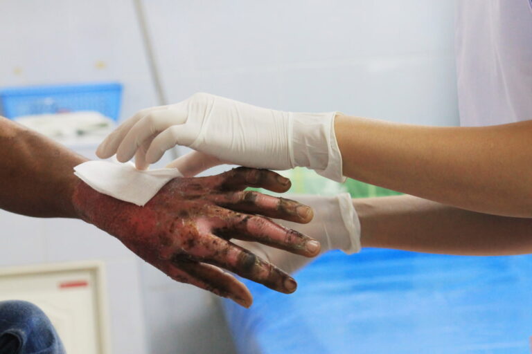 nurse's gloved hands bandaging a patient's burned hand