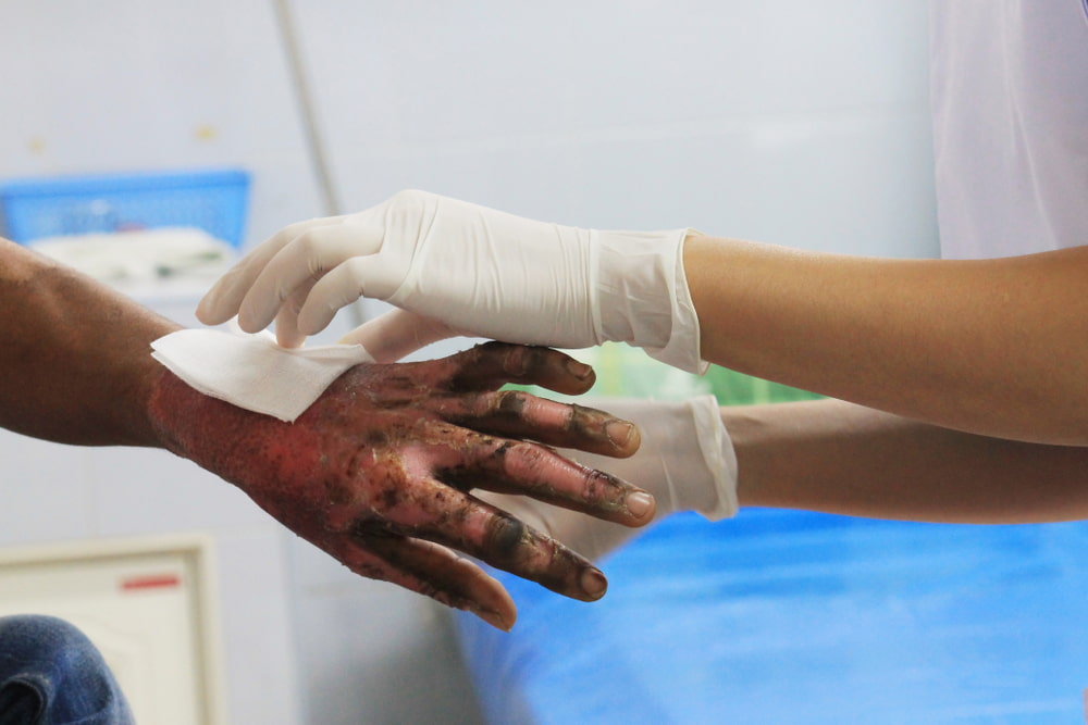 nurse's gloved hands bandaging a patient's burned hand